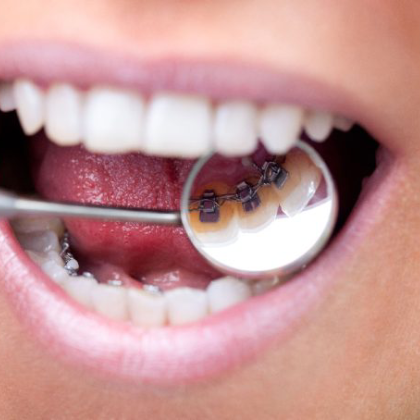 Lingual Braces vs. Traditional Metal Braces: Which Option Fits Your Lifestyle?