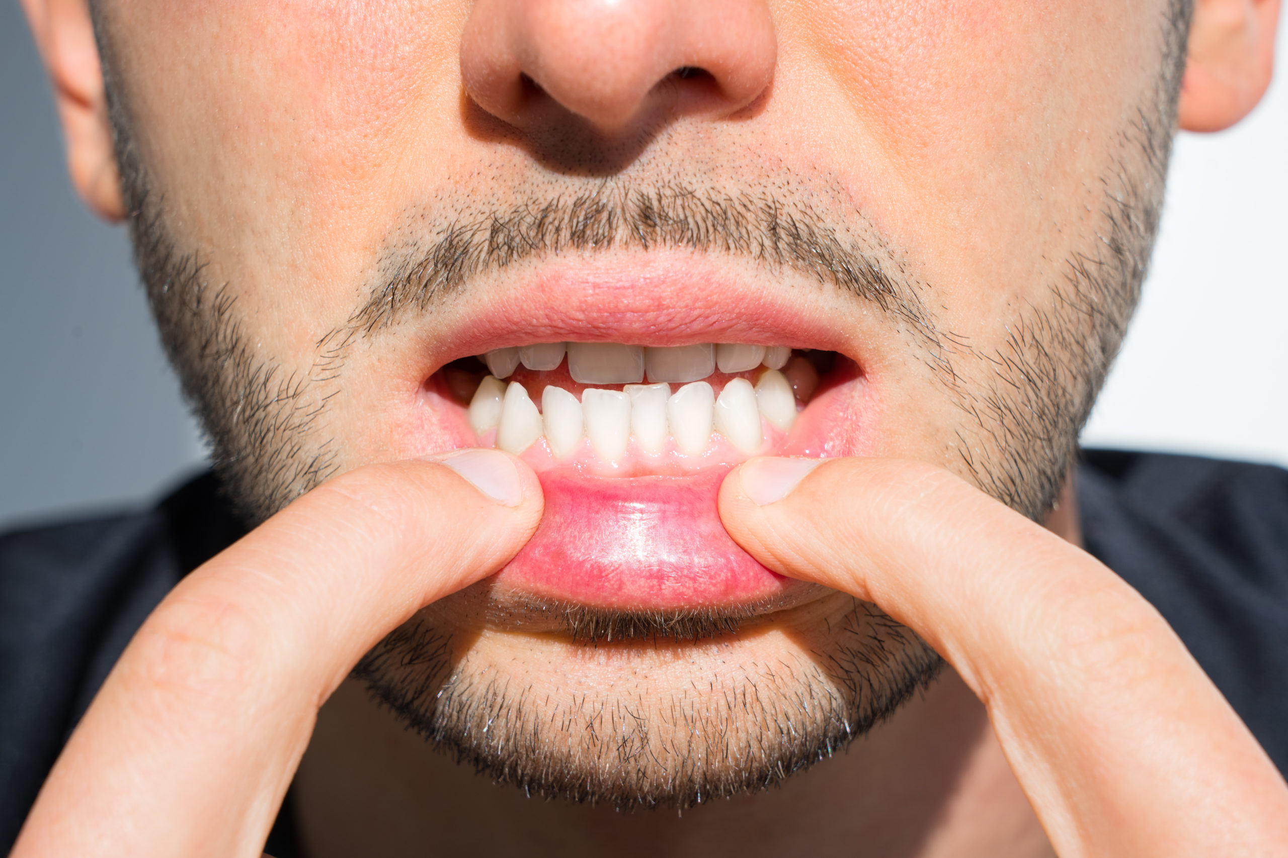 Can Invisalign Fix Crooked Teeth?