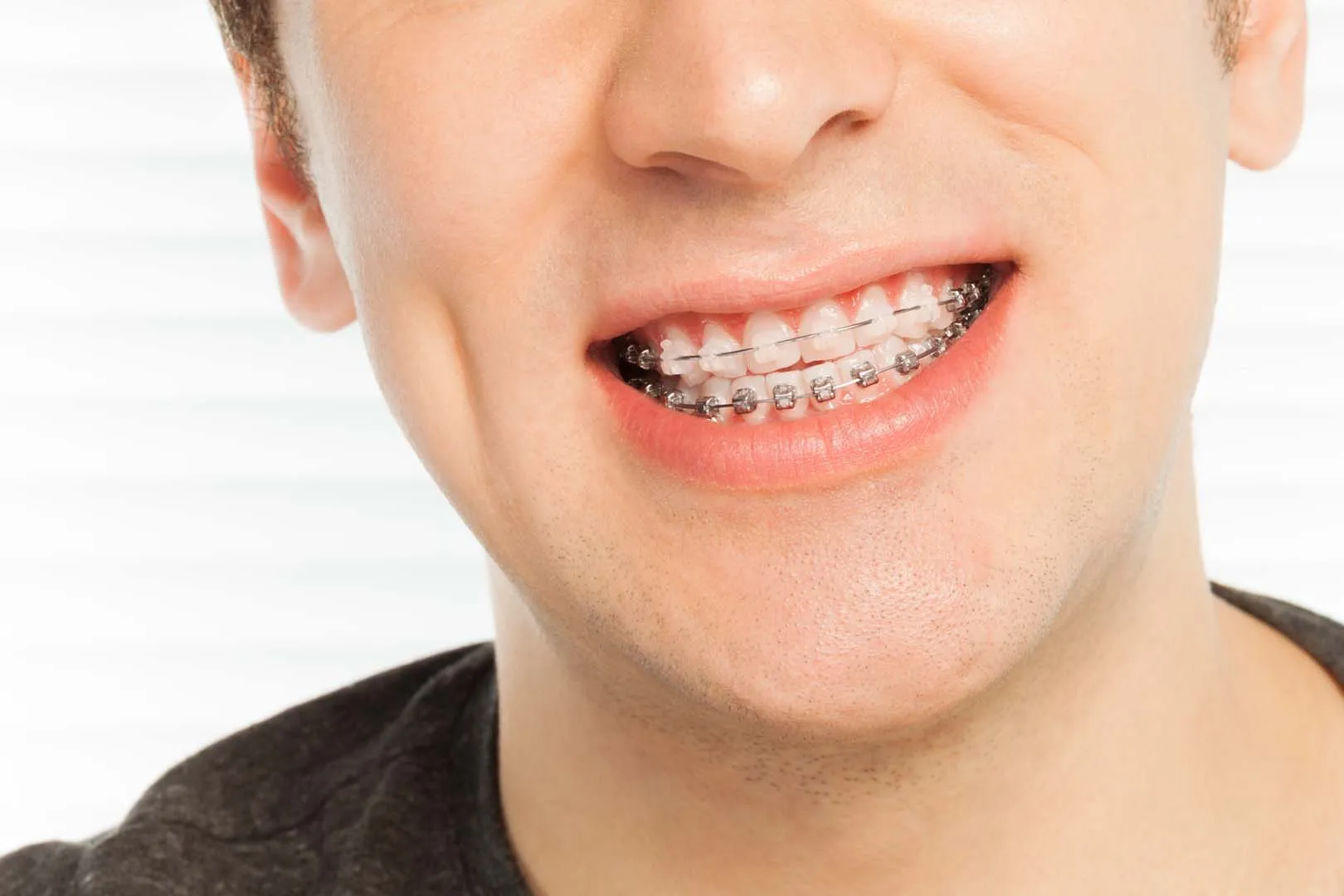 Do Clear Braces Stain or Discolor Over Time?
